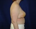 breast reduction photograph 1 week after 316.JPG