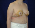 breast reduction photo_317.JPG