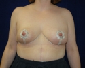 breast reduction one month after picture_318.JPG