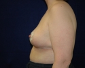 breast reduction after picture 1 month_319.JPG