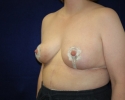 1 month after breast reduction photo_320.JPG
