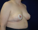 breast reduction 1 month after photo_321.JPG