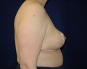 breast reduction one month after picture_322.JPG