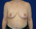 breast reduction picture 6 months after_334.JPG