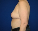 breast reduction 6 month after photo_335.JPG
