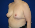 breast reduction 6 month after photo_337.JPG