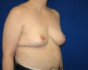 breast reduction after photos_338.JPG