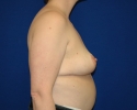 breast reduction photo 6 months after surgery_339.JPG