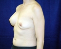 Breast implant deflation pictures 302.JPG