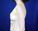 Breast implant deflation pictures 303.JPG