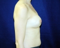 Breast implant deflation pictures 304.JPG