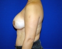breast_implant_photo_exchange_1408.JPG