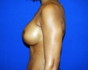 breast_implant_photo_exchange_1629.JPG
