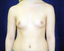 breast_implant_photo_exchange_1705.JPG