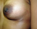 breast_implant_photo_exchange_1808.JPG