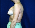 breast_photo_capsular_contacture103.JPG