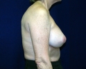 breast_photo_capsular_contacture108.JPG