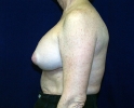 breast_photo_capsular_contacture110.JPG