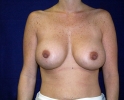 breast_implant_photo_exchange_501.JPG