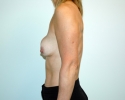 Breast implant exchange with breast lift pictures 903.JPG