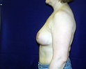 breast_augmentation_photo_removal303.JPG