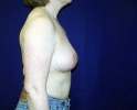 breast_augmentation_photo_removal306.JPG