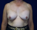 breast_augmentation_photo_removal101.JPG