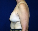 breast_augmentation_photo_removal102.JPG