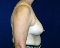 breast_augmentation_photo_removal103.JPG
