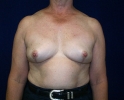 breast_augmentation_photo_removal106.JPG