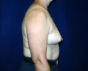 breast_augmentation_photo_removal108.JPG