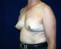 breast_augmentation_photo_removal109.JPG