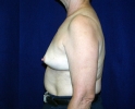breast_augmentation_photo_removal110.JPG