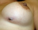 breast_augmentation_photo_infection_203.JPG