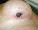 breast_augmentation_photo_infection_210.JPG