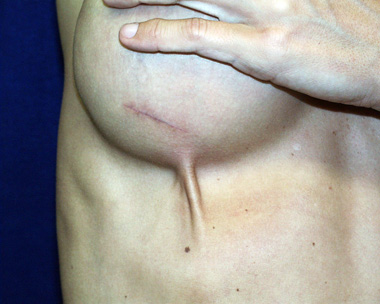 mondors disease, mondors cords, mondors bands, after breast augmentation Virginia