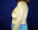Breast reconstruction pictures 103.JPG
