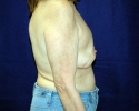 Breast reconstruction pictures _104.JPG