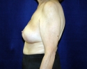 Breast reconstruction pictures 108.JPG