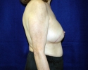 Breast reconstruction pictures 109.JPG