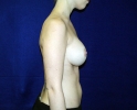 breast_implant_photo_lpfo_cor_203.JPG