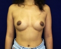 Breast augmentation photos _stretch_506.JPG