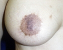 Symmastia pictures _photo_syn_106.JPG