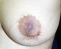 Symmastia pictures _photo_syn_107.JPG