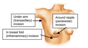 breast augmentation incisions breast implant scars