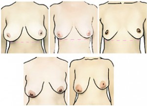breast development asymmetry virginia