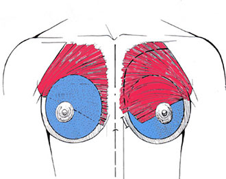 breast implants positions