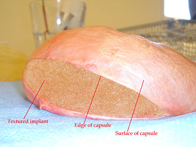 breast implant capsular contracture virginia