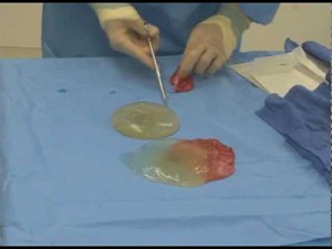 breast implant life expectancy