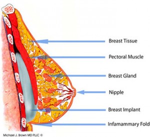 breast implants position cross section